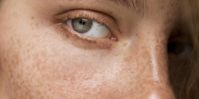 Quelles astuces naturelles pour éliminer les taches brunes sur le visage ?